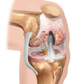 Action cream Arthrose